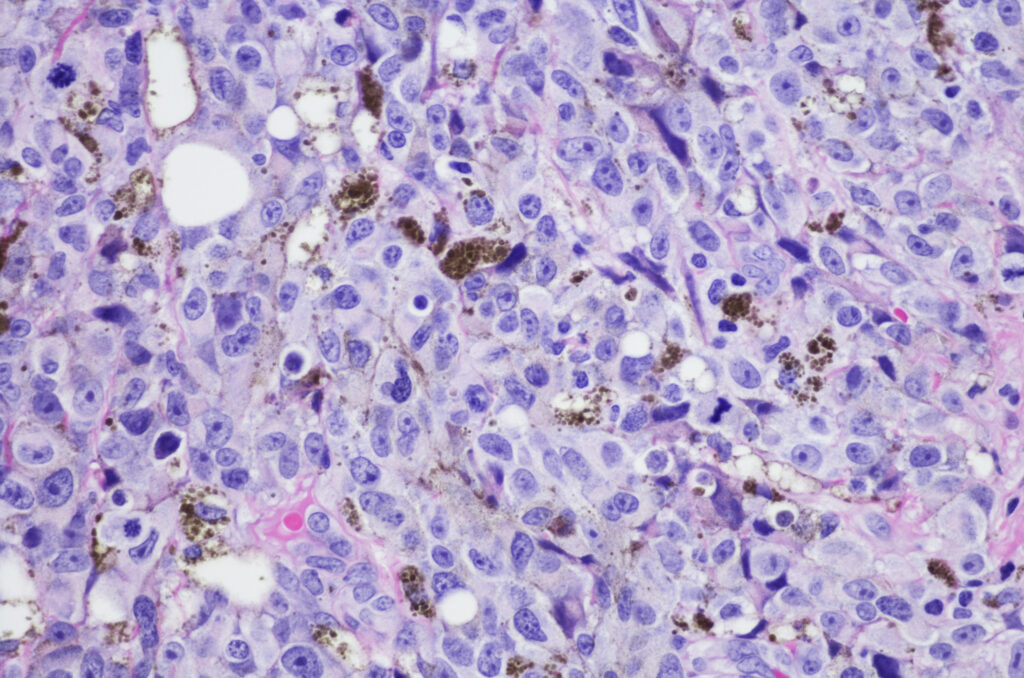 Digital image of melanoma under a microscope