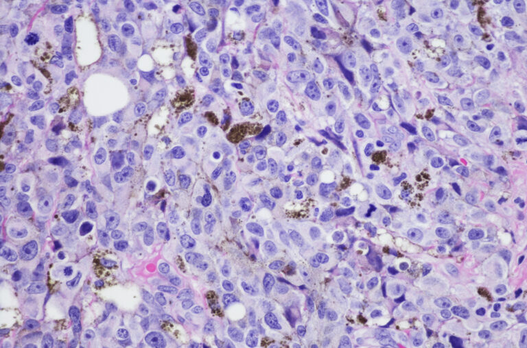 Digital image of melanoma under a microscope