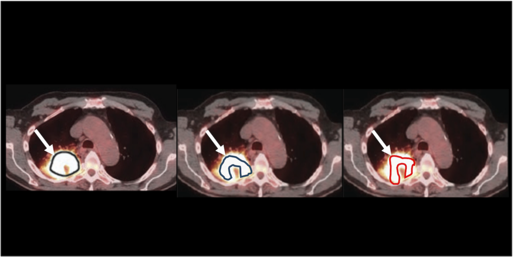 How can quantitative imaging methods be evaluated without knowing the truth? In this example, three tumor-delineation methods yield different tumor-volume estimates from the same clinical image. Without knowing the true tumor volume, it is difficult to determine which method among these performs best. The proposed NGSE-Corr technique provides a way to compare such methods without requiring knowledge of the true value.