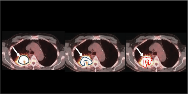 How can quantitative imaging methods be evaluated without knowing the truth? In this example, three tumor-delineation methods yield different tumor-volume estimates from the same clinical image. Without knowing the true tumor volume, it is difficult to determine which method among these performs best. The proposed NGSE-Corr technique provides a way to compare such methods without requiring knowledge of the true value.