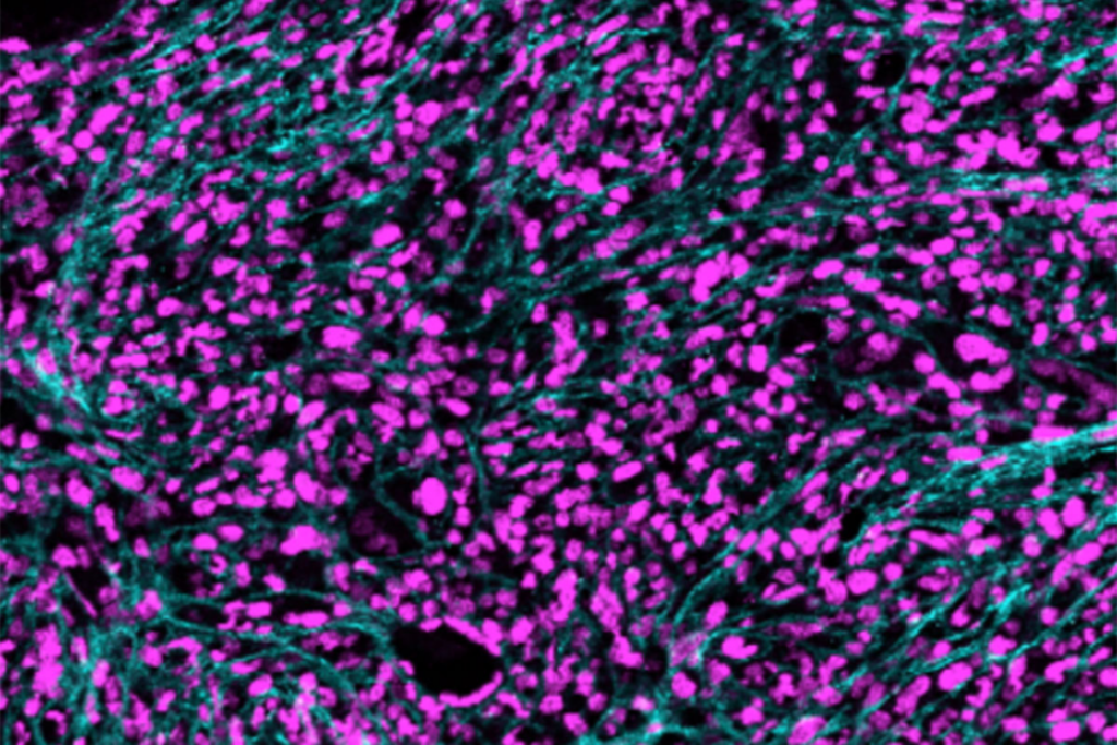 A new NIH grant to WashU Medicine supports research into myeloproliferative neoplasms (MPNs), a group of blood cancers. In an MPN called myelofibrosis, reticulin fibers (in cyan) infiltrate the bone marrow.