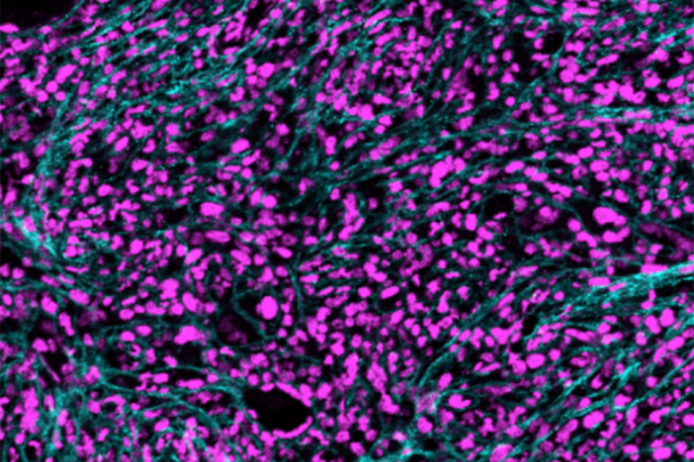 A new NIH grant to WashU Medicine supports research into myeloproliferative neoplasms (MPNs), a group of blood cancers. In an MPN called myelofibrosis, reticulin fibers (in cyan) infiltrate the bone marrow.