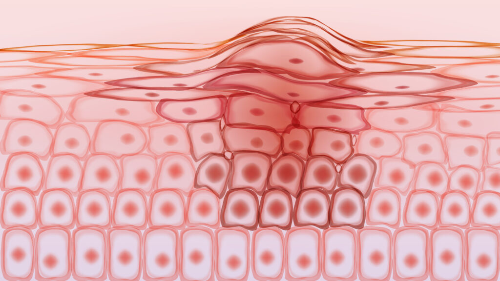 Medical illustration of skin layers showing abnormal cell growth and a raised lesion.