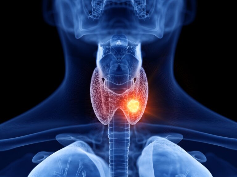 Medical illustration highlighting a glowing nodule on the thyroid gland within the neck.
